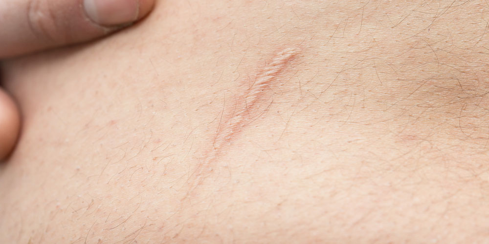 Scar Revision