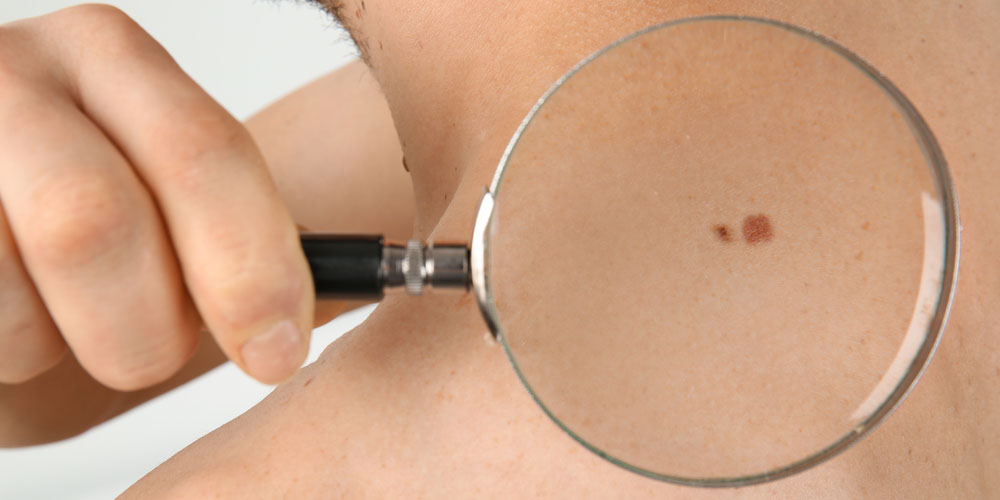 Moles, Cysts and Lipomas